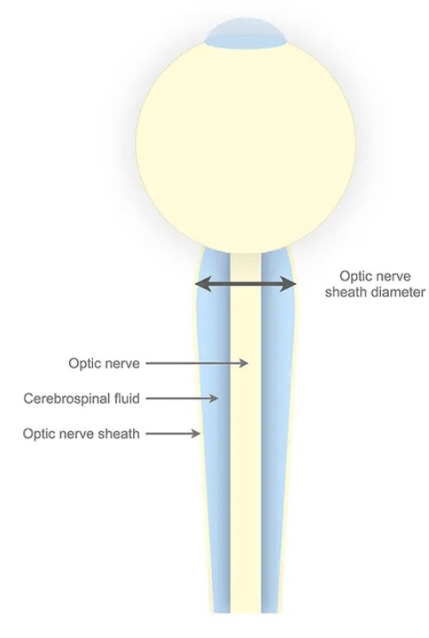 optical nerve sheath