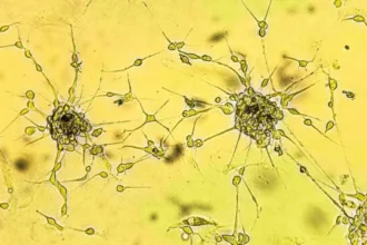 Glioblastoma 642x361 2