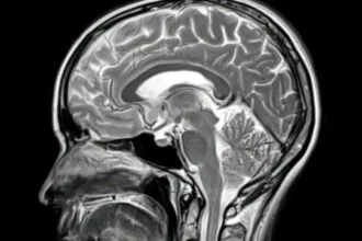 کالبدشکافی نادر نشان می‌دهد داروهای آلزایمر فقط در برخی نواحی مغز مؤثرند
