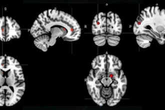 BrainScansDepression