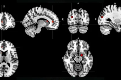 BrainScansDepression