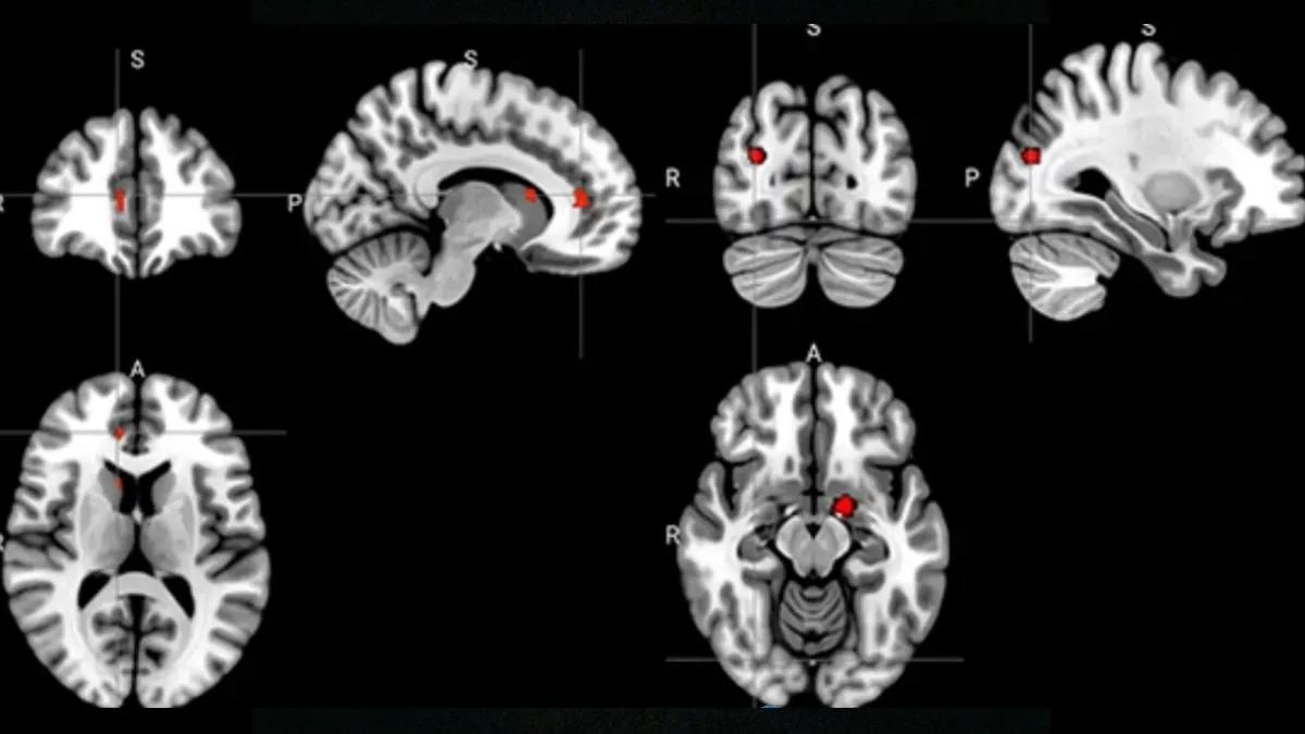 BrainScansDepression