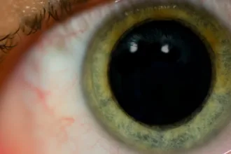 dilated pupil