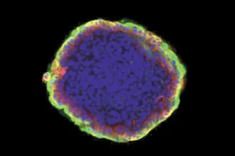 tumor organoid