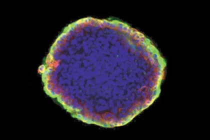 tumor organoid