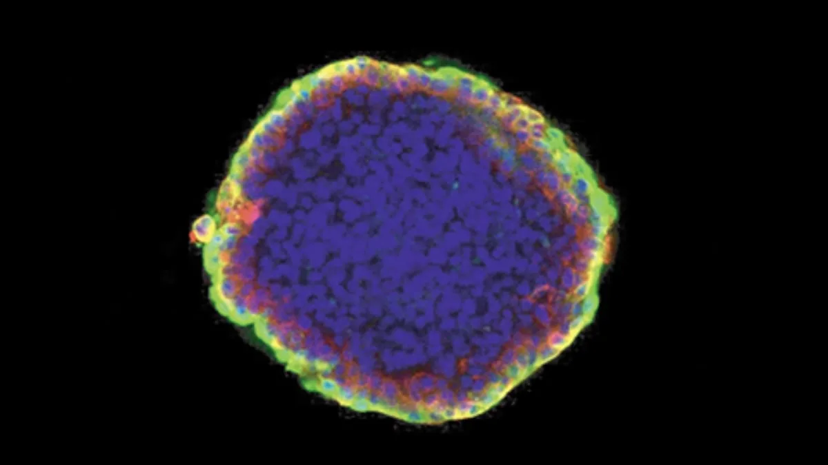 tumor organoid