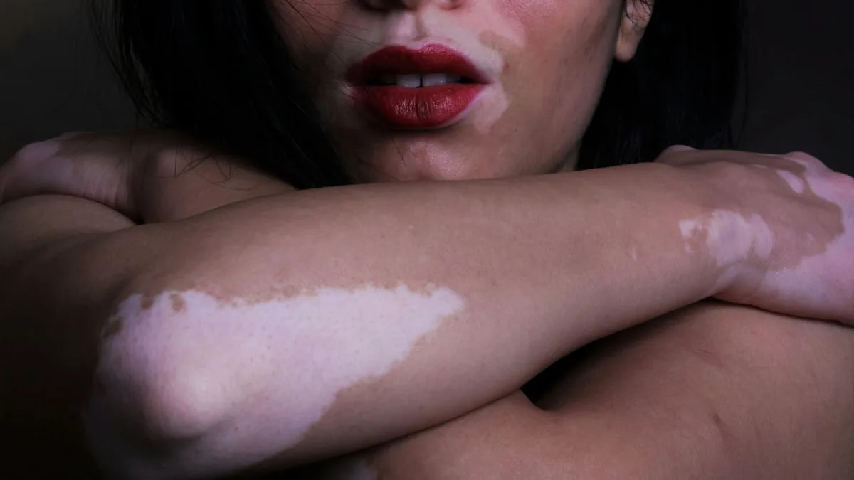 woman with vitiligo